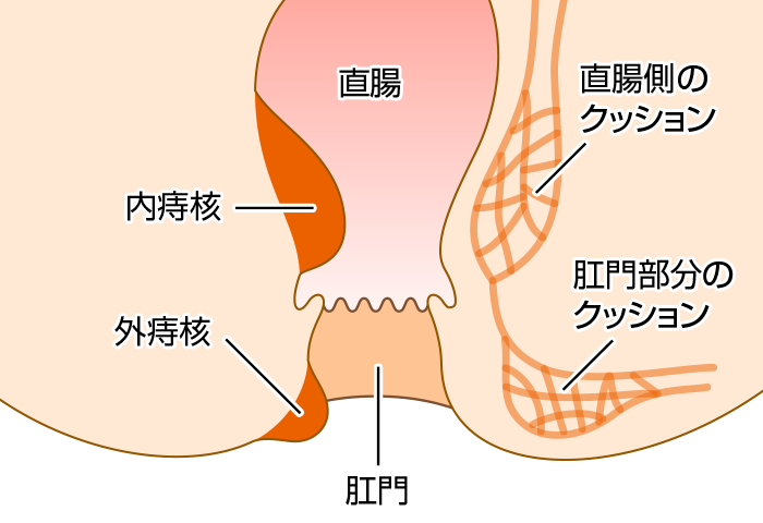 痔核（いぼ痔）の患部構造図
