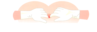 用手肛門拡張手術イメージ