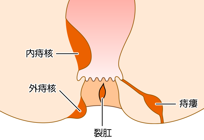 内痔核、外痔核、裂肛、痔瘻の場所説明図