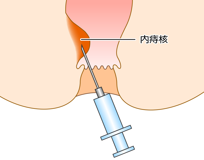 痔核 いぼ痔 の治療 痔の総合情報サイト 痔 Web