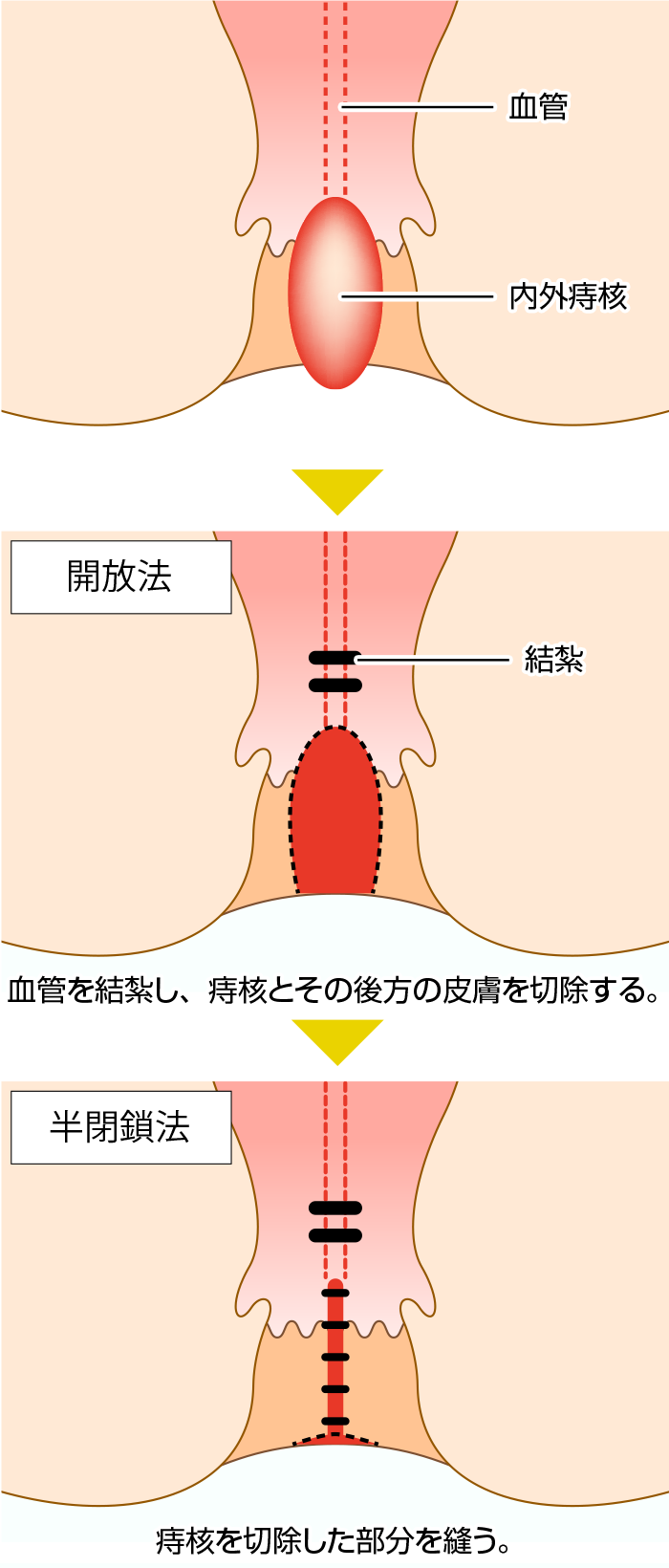 結紮切除術