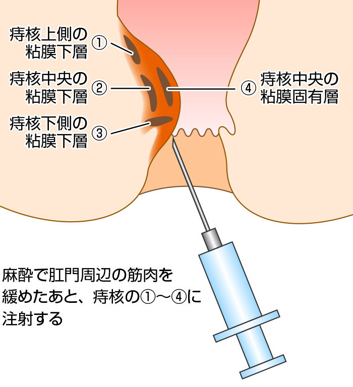 治療 いぼ 法 痔