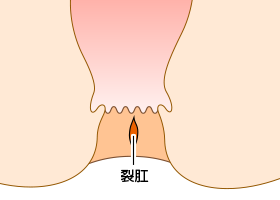 裂肛の急性期