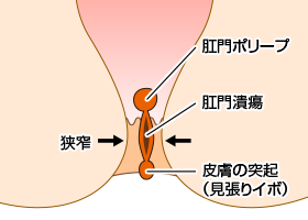 裂肛の慢性期