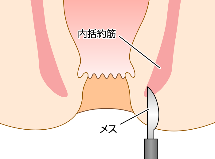 内括約筋側方皮下切開術