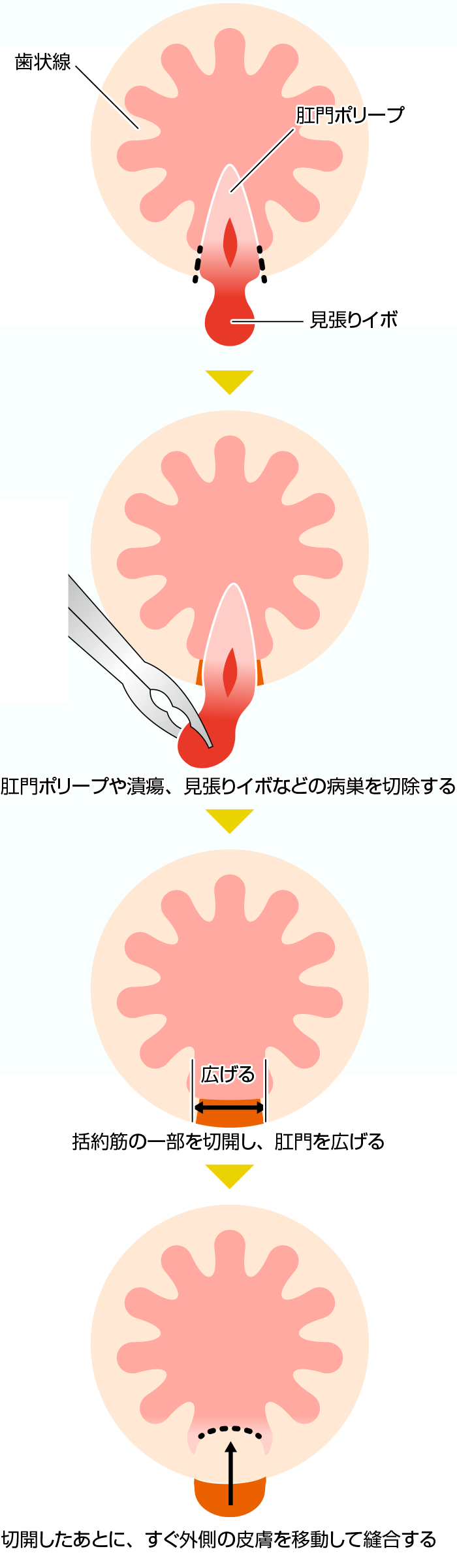 裂肛 切れ痔 の治療 痔の総合情報サイト 痔 Web