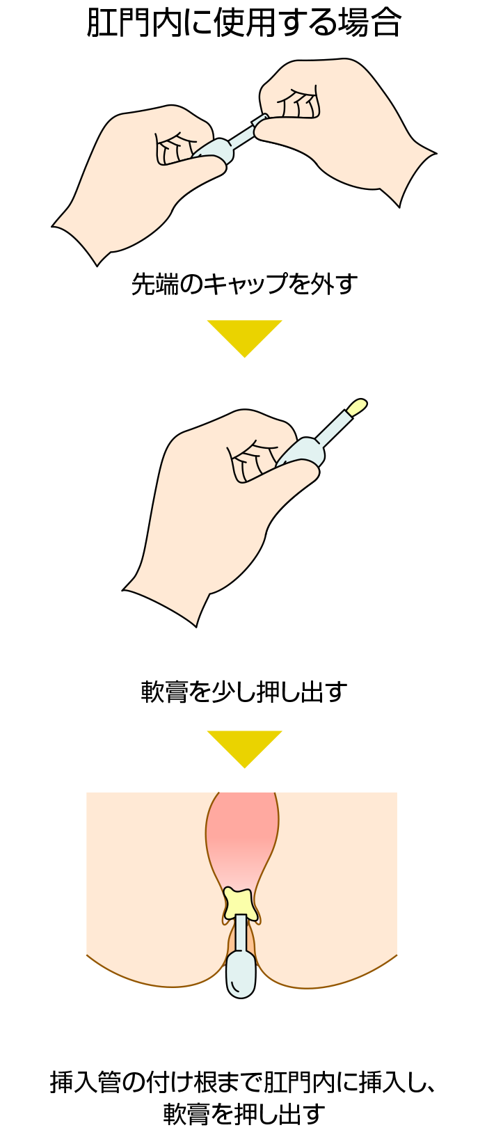 肛門内に使用する軟膏の使い方