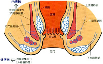 痔とは？