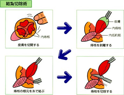 結紮切除術