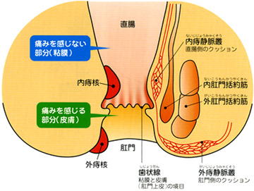 痔核（いぼ痔）