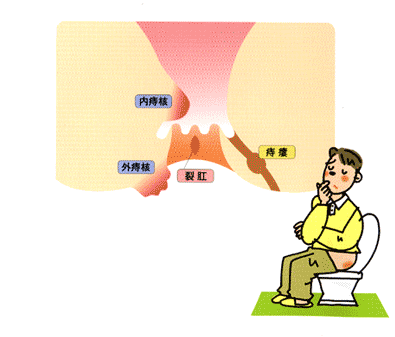 痔の種類