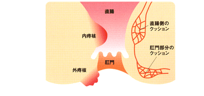 痔核の説明図