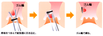 ゴム輪結紮療法の説明図