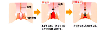 結紮切除術の説明図