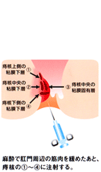 麻酔で肛門周辺の筋肉を緩めたあと、 痔核の①～④に注射する。