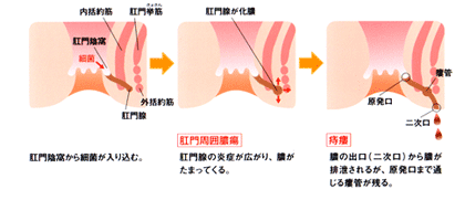 痔瘻の説明図