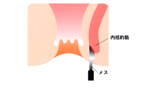 内括約筋側方皮下切開術イメージ