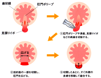 皮膚弁移動術イメージ