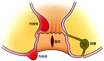 痔ろう・裂肛・肛門周囲膿瘍・痔ろう