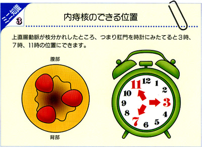 内痔核のできる位置