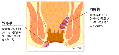 外痔核 歯状線より下のクッション部分がうっ血して大きくなったもの。  内痔核 歯状線より上のクッション部分がうっ血して大きくなったもの。