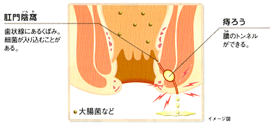 肛門陰窩、痔ろう